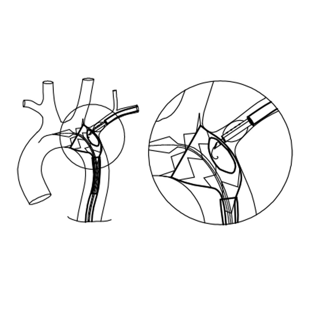 Ankura TAA Stent Graft System Fenestrierungssystem FuThrough 